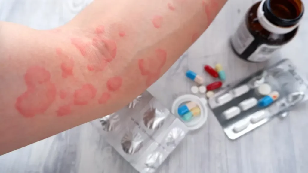 علائم حساسیت به طلا چیست؟