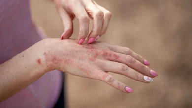 علائم حساسیت به طلا