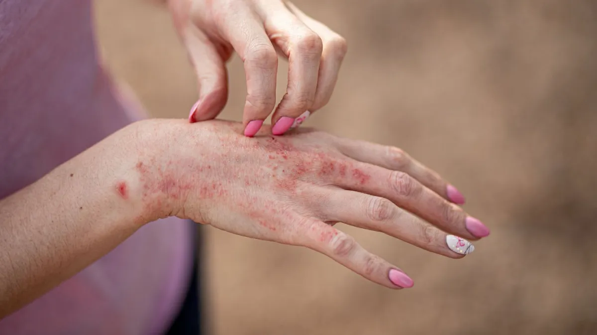 علائم حساسیت به طلا